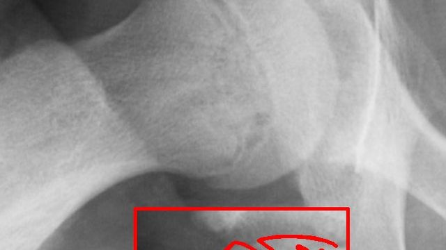 SUFE and Perthes' Disease: Classification, Management and Prognosis — orthointerview.com