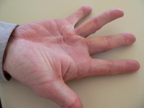 Dupuytren's Disease — orthointerview.com