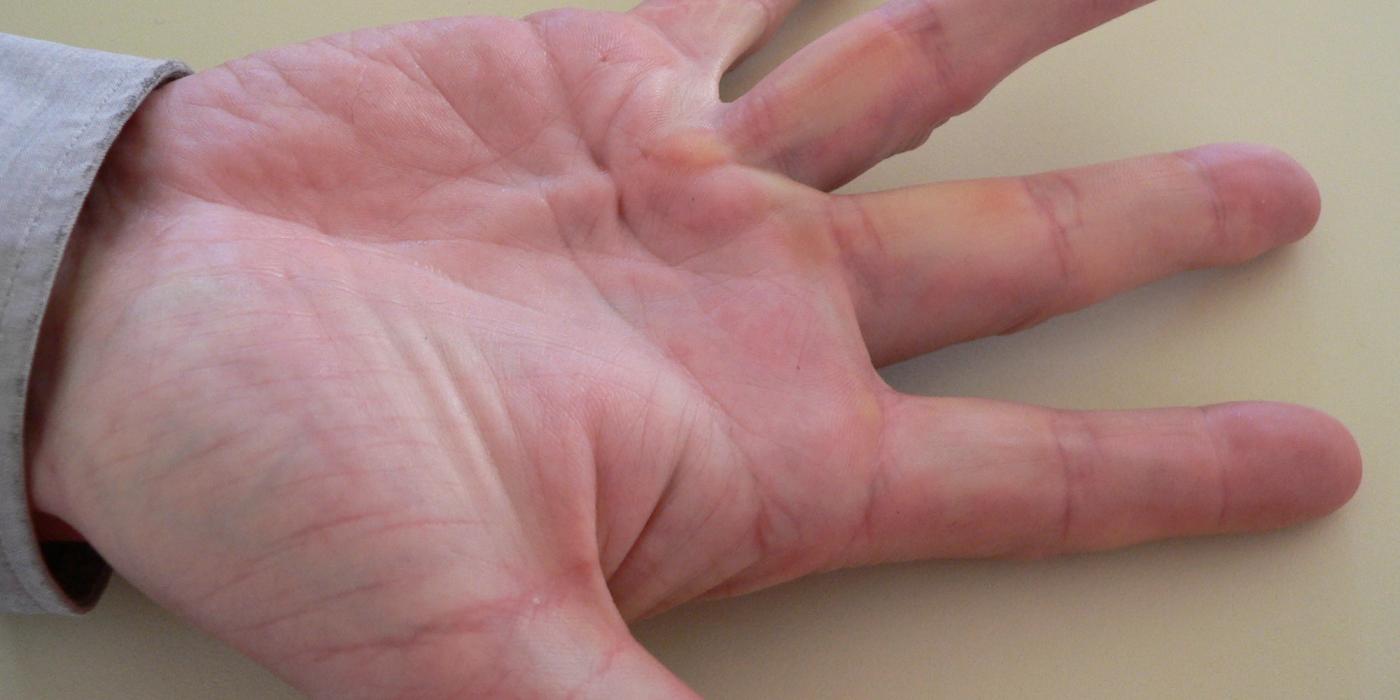 Dupuytren's Disease — orthointerview.com
