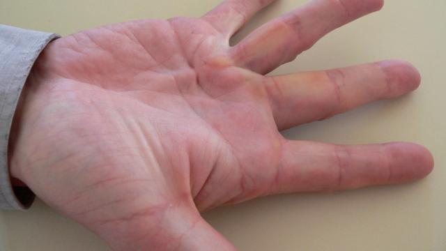 Dupuytren's Disease — orthointerview.com