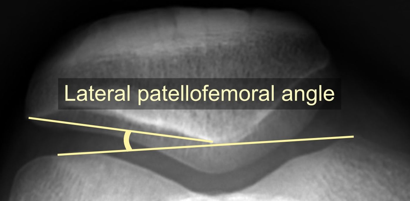 First-Time Patellar Dislocation: Assessment and Management (Dec 2024 BOAST) — orthointerview.com