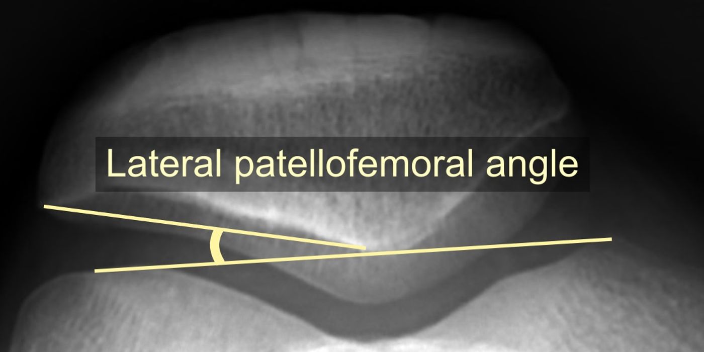 First-Time Patellar Dislocation: Assessment and Management (Dec 2024 BOAST) — orthointerview.com