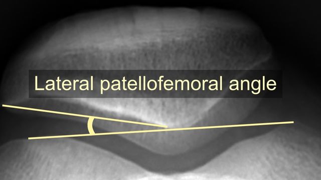 First-Time Patellar Dislocation: Assessment and Management (Dec 2024 BOAST) — orthointerview.com