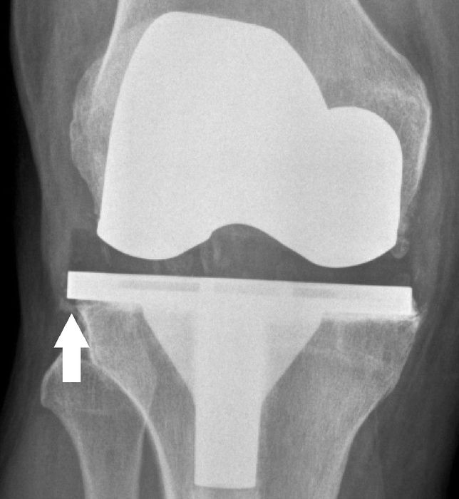 Periprosthetic Joint Infection (PJI) — orthointerview.com