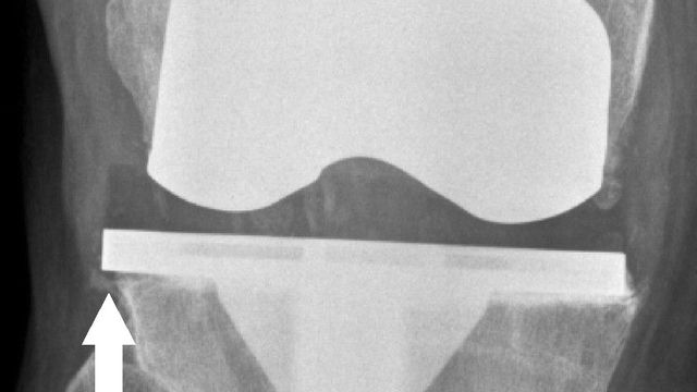 Periprosthetic Joint Infection (PJI) — orthointerview.com