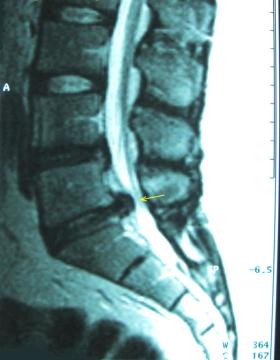 Cauda Equina Syndrome: Red Flags, Emergency MRI and the National (GIRFT) Pathway — orthointerview.com