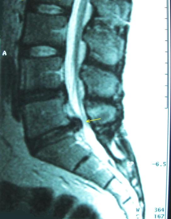 Cauda Equina Syndrome: Red Flags, Emergency MRI and the National (GIRFT) Pathway — orthointerview.com