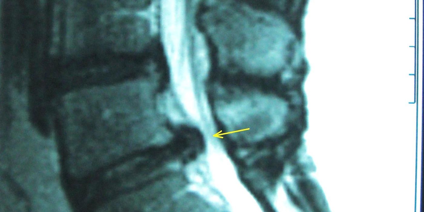 Cauda Equina Syndrome: Red Flags, Emergency MRI and the National (GIRFT) Pathway — orthointerview.com