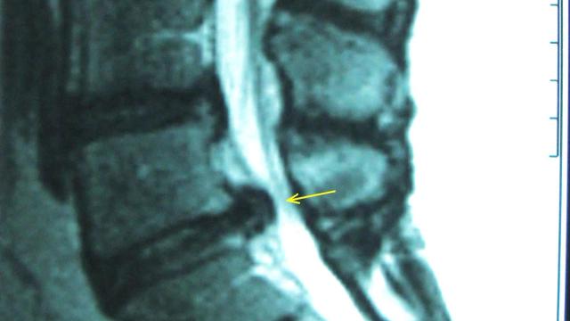 Cauda Equina Syndrome: Red Flags, Emergency MRI and the National (GIRFT) Pathway — orthointerview.com