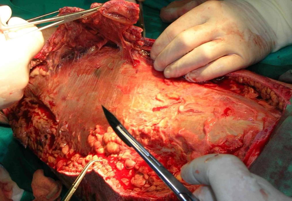 Necrotising Fasciitis and Severe Soft-Tissue Infections — orthointerview.com