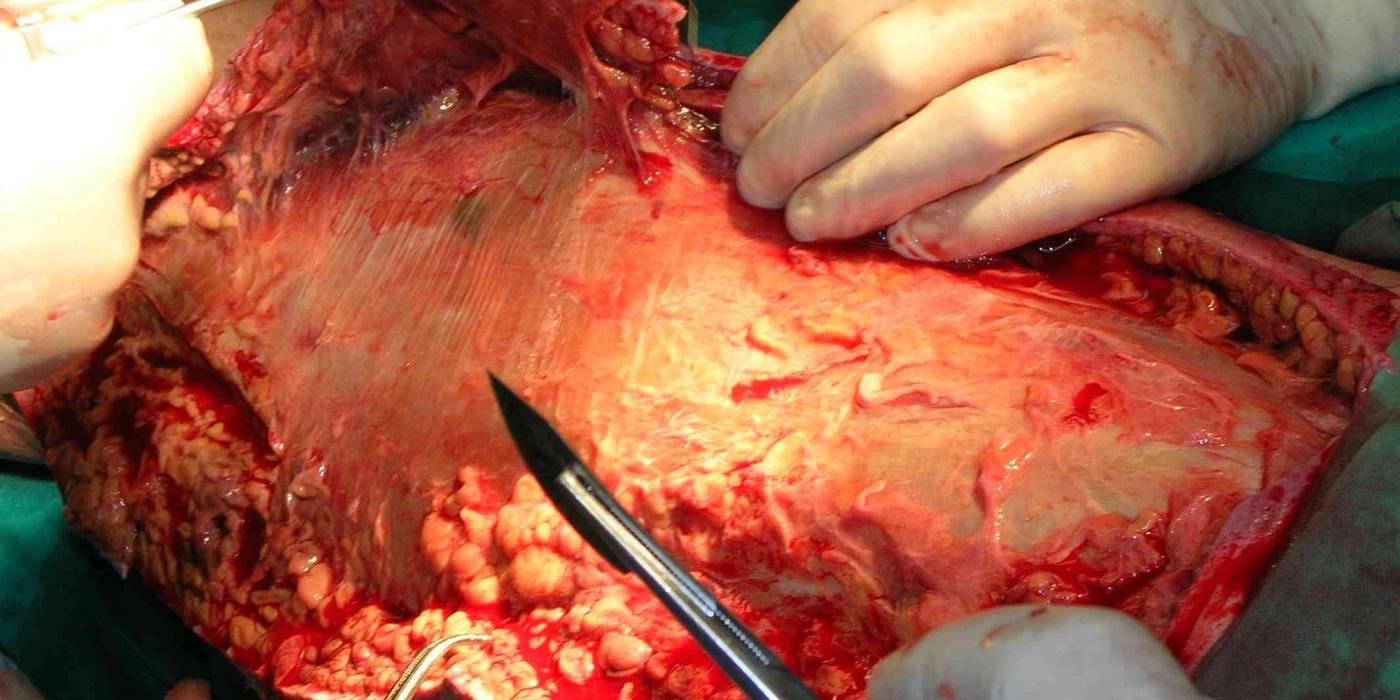 Necrotising Fasciitis and Severe Soft-Tissue Infections — orthointerview.com