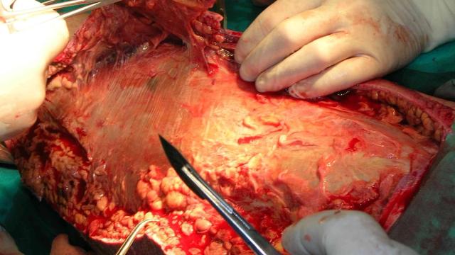 Necrotising Fasciitis and Severe Soft-Tissue Infections — orthointerview.com