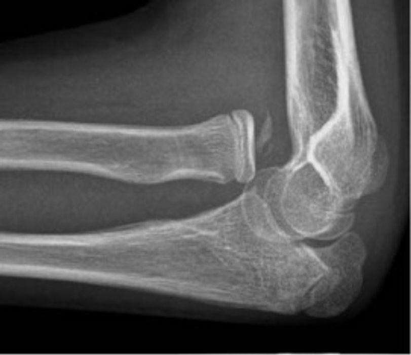 Elbow Injuries: Terrible Triad, Radial Head and Olecranon Fractures, and Dislocation — orthointerview.com