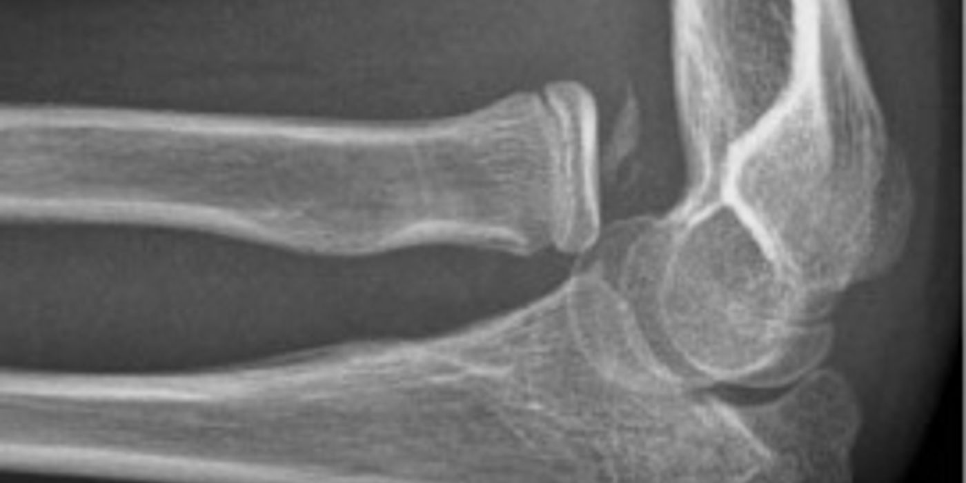 Elbow Injuries: Terrible Triad, Radial Head and Olecranon Fractures, and Dislocation — orthointerview.com