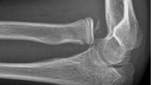 Elbow Injuries: Terrible Triad, Radial Head and Olecranon Fractures, and Dislocation — orthointerview.com
