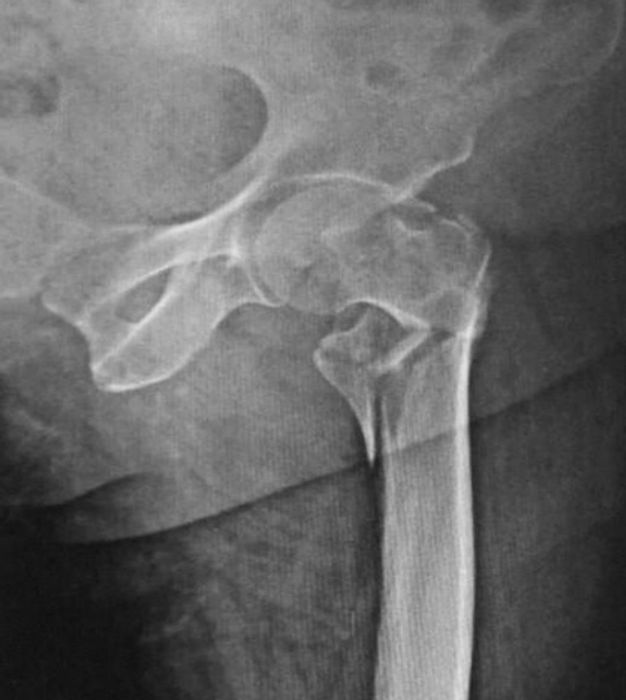 Hip Fractures (Neck of Femur): Classification, NICE-Aligned Management and the 36-Hour Target — orthointerview.com