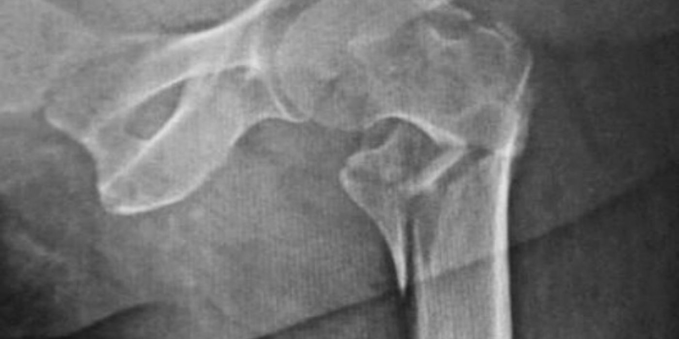 Hip Fractures (Neck of Femur): Classification, NICE-Aligned Management and the 36-Hour Target — orthointerview.com