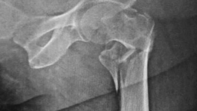 Hip Fractures (Neck of Femur): Classification, NICE-Aligned Management and the 36-Hour Target — orthointerview.com