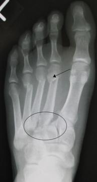 Lisfranc Injuries — orthointerview.com