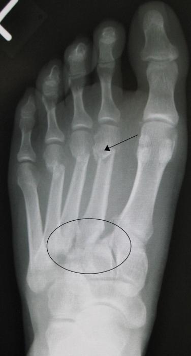 Lisfranc Injuries — orthointerview.com