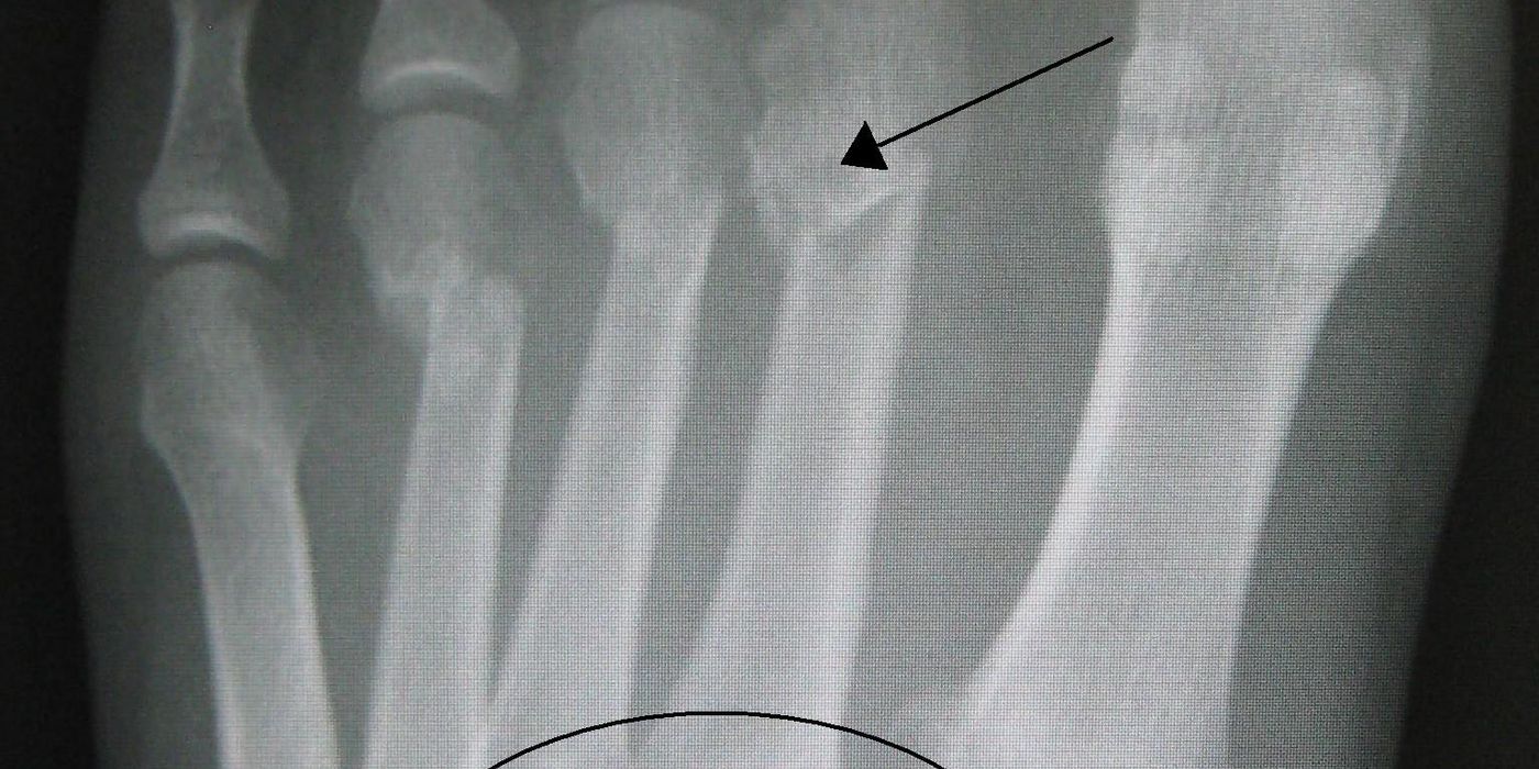 Lisfranc Injuries — orthointerview.com