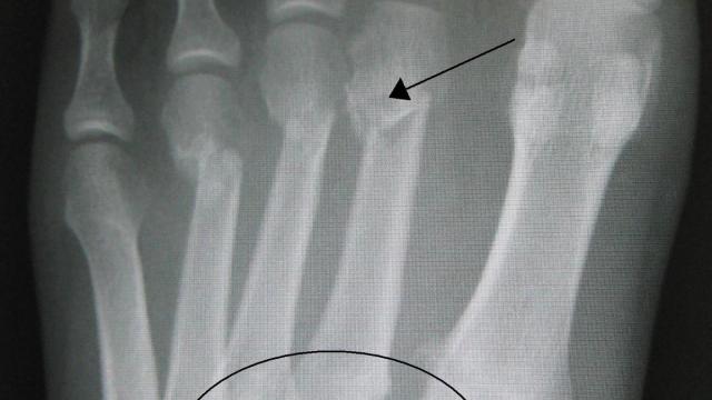 Lisfranc Injuries — orthointerview.com