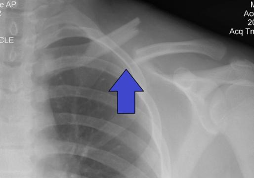 Clavicle Fractures: Classification, Evidence and Management — orthointerview.com