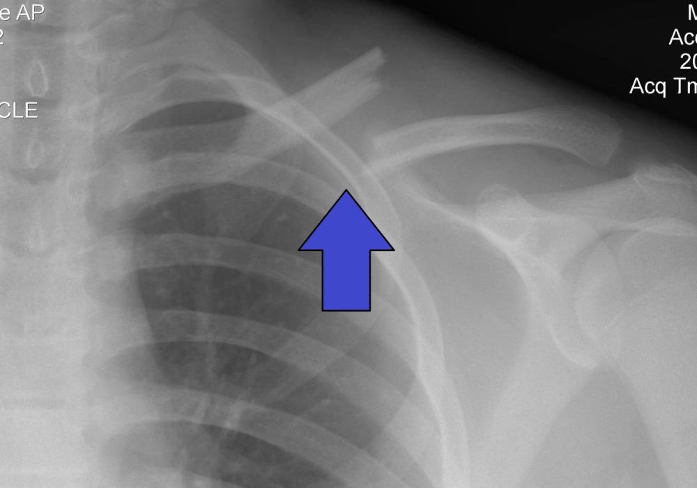 Clavicle Fractures: Classification, Evidence and Management — orthointerview.com