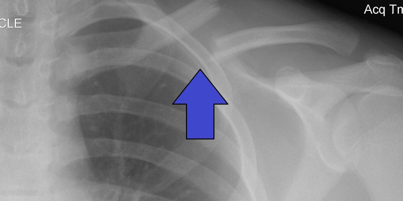 Clavicle Fractures: Classification, Evidence and Management — orthointerview.com