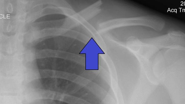 Clavicle Fractures: Classification, Evidence and Management — orthointerview.com