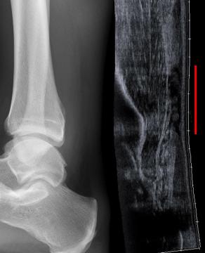 Achilles Tendon Rupture: Diagnosis, UKSTAR Evidence and Management — orthointerview.com