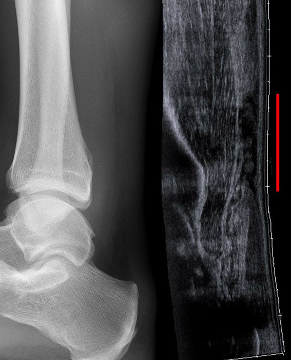 Achilles Tendon Rupture: Diagnosis, UKSTAR Evidence and Management — orthointerview.com