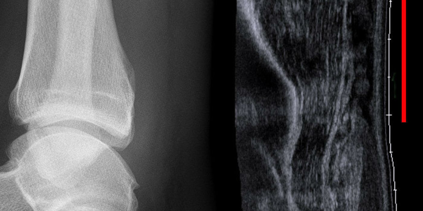 Achilles Tendon Rupture: Diagnosis, UKSTAR Evidence and Management — orthointerview.com