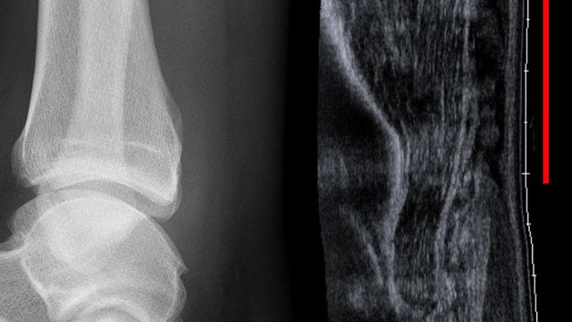 Achilles Tendon Rupture: Diagnosis, UKSTAR Evidence and Management — orthointerview.com