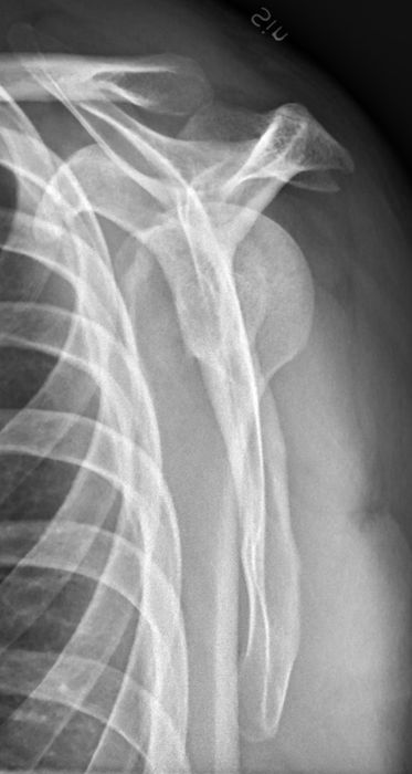 Shoulder Dislocation and Instability — orthointerview.com