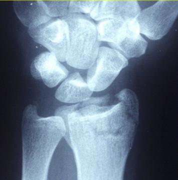 Distal Radius Fractures: Assessment, Management and the Evidence (BOAST, NICE NG38, DRAFFT) — orthointerview.com