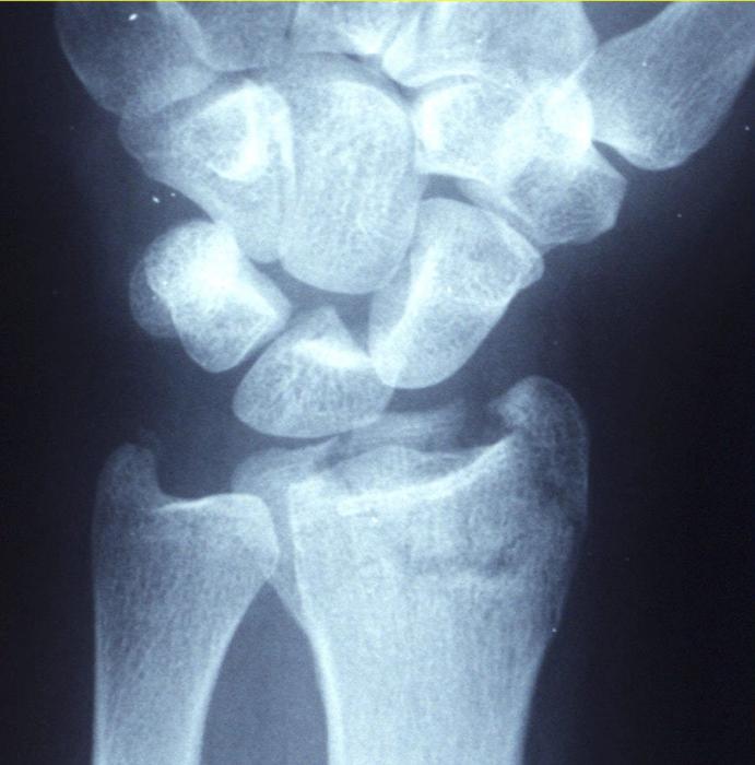 Distal Radius Fractures: Assessment, Management and the Evidence (BOAST, NICE NG38, DRAFFT) — orthointerview.com
