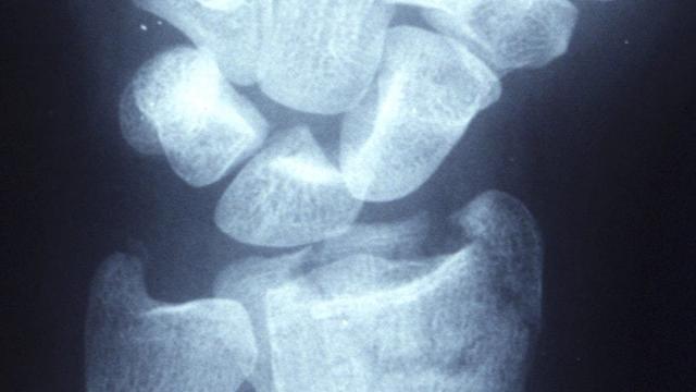 Distal Radius Fractures: Assessment, Management and the Evidence (BOAST, NICE NG38, DRAFFT) — orthointerview.com