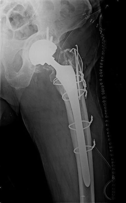 Periprosthetic Hip Fractures — orthointerview.com