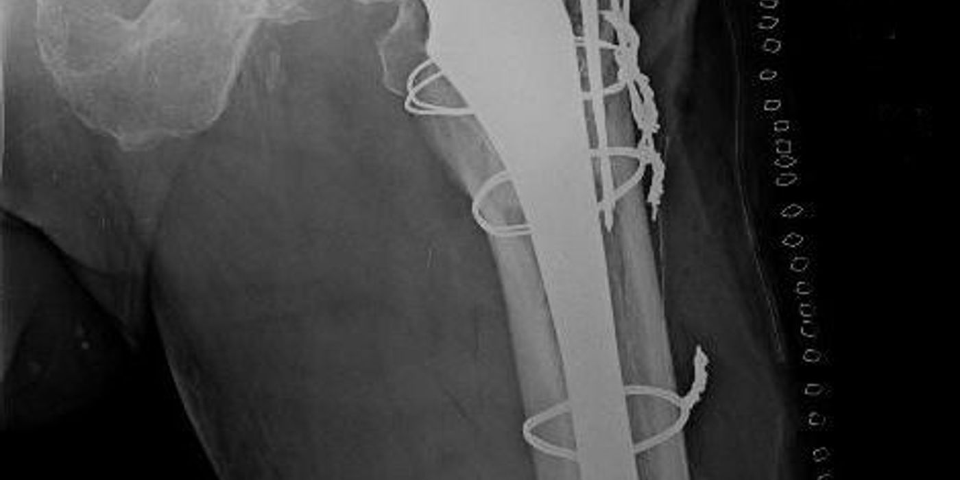 Periprosthetic Hip Fractures — orthointerview.com