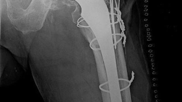 Periprosthetic Hip Fractures — orthointerview.com