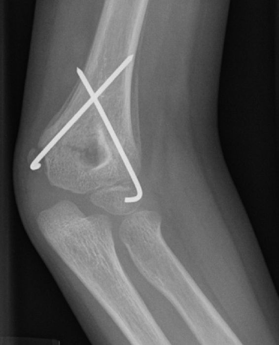 Supracondylar Fractures of the Humerus in Children — orthointerview.com