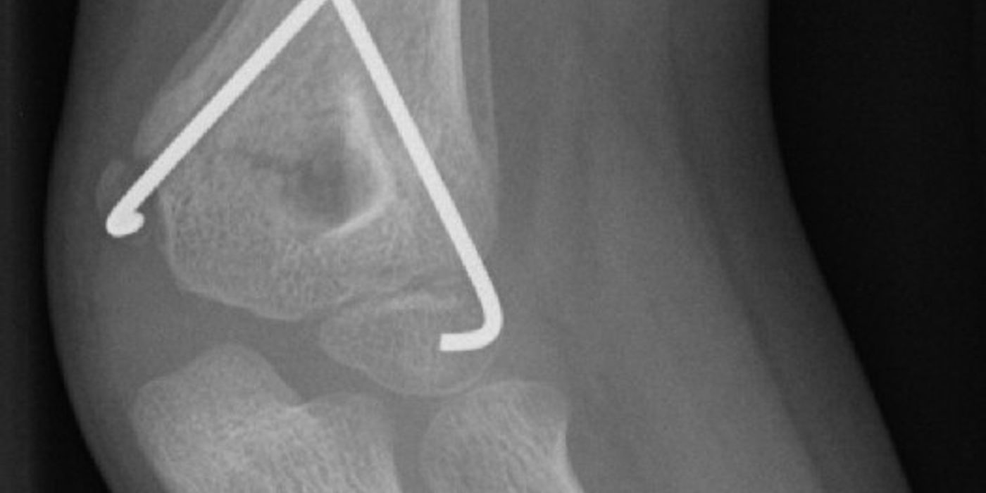 Supracondylar Fractures of the Humerus in Children — orthointerview.com