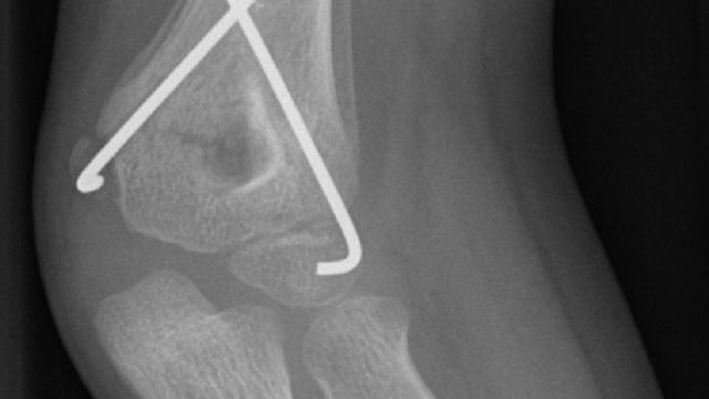 Supracondylar Fractures of the Humerus in Children — orthointerview.com