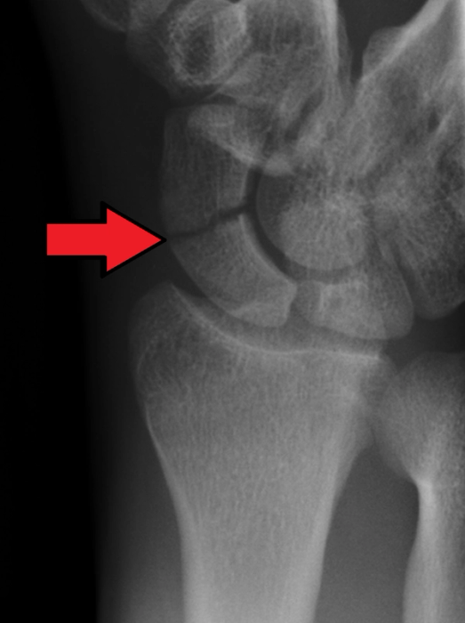 Scaphoid Fractures: Diagnosis, Management and Nonunion — orthointerview.com