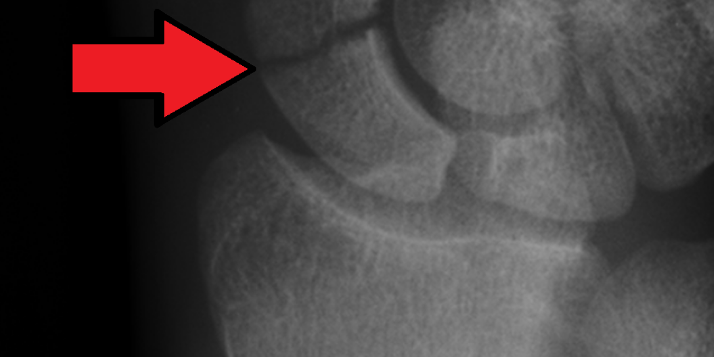 Scaphoid Fractures: Diagnosis, Management and Nonunion — orthointerview.com