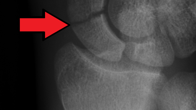 Scaphoid Fractures: Diagnosis, Management and Nonunion — orthointerview.com