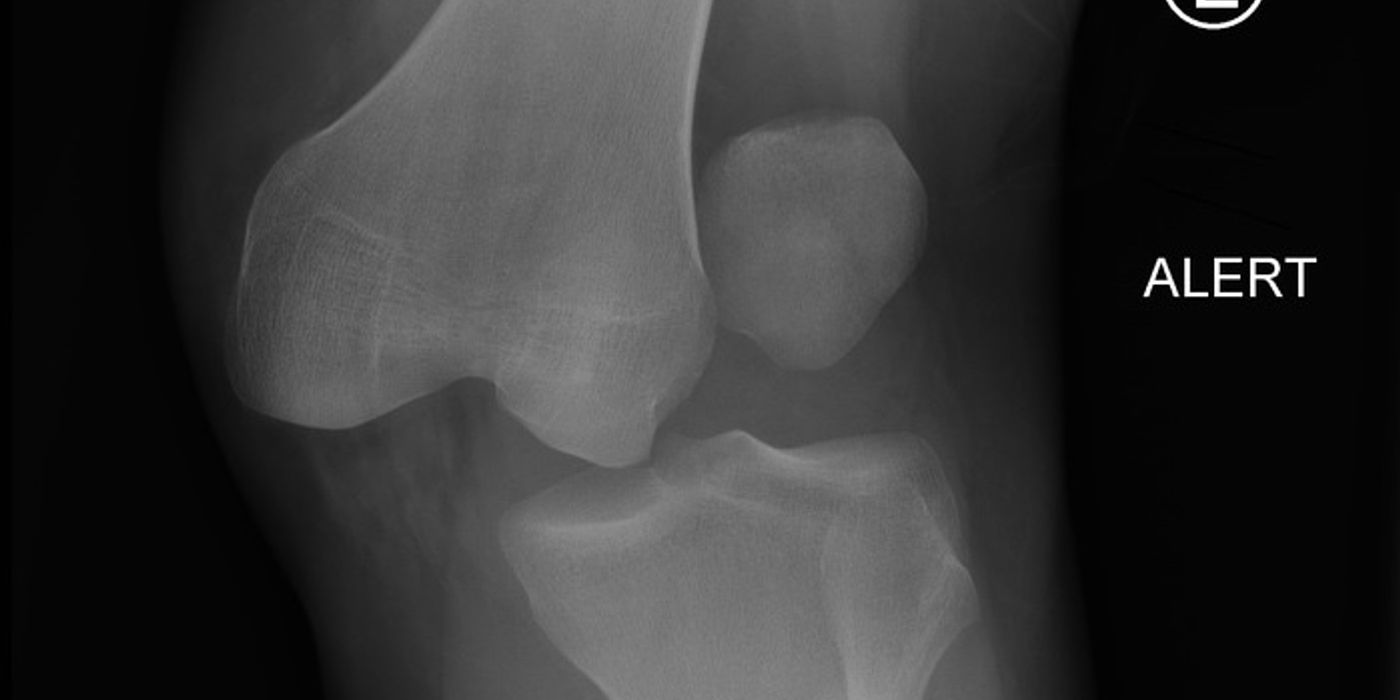 Knee Dislocation and Multiligament Injury — orthointerview.com