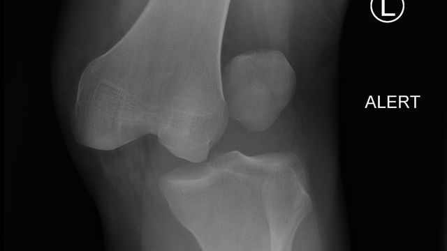Knee Dislocation and Multiligament Injury — orthointerview.com