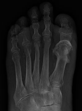 Fracture-Related Infection and Osteomyelitis — orthointerview.com